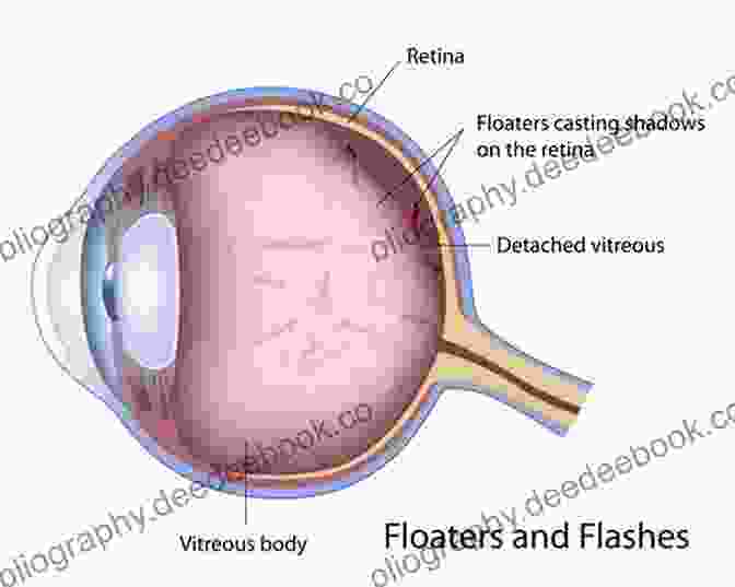 Diagram Of Vitreous Humor And Floaters Eye Floaters Vitreous Opacity Or Light Of Consciousness?: Floaters Between Science And Religion A Challenge To Ophthalmology Visual Nervous System Migraine Aura